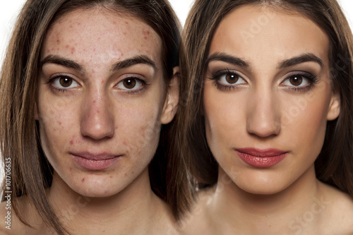 Comparison portrait of a woman with problematic skin without and with makeup