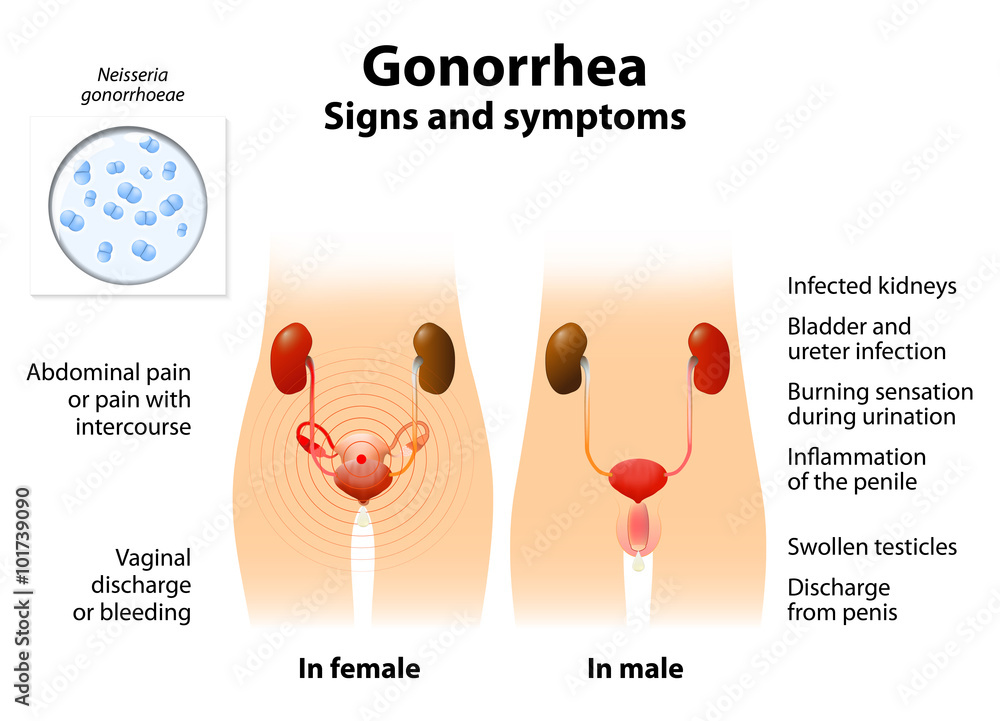 Φωτογραφία Gonorrhea or gonnococcal infection