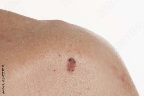 keratinizing squamous cell carcinoma of the skin