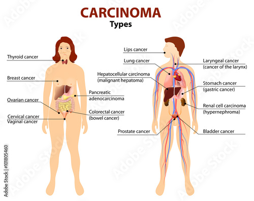 Carcinoma