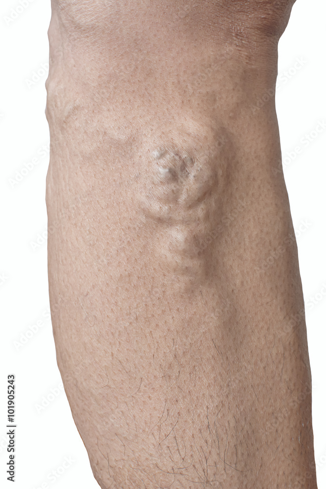Fototapeta premium isolated irregular varicose veins on woman leg