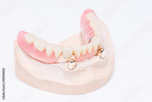 Teleskopprothese, telescopic denture