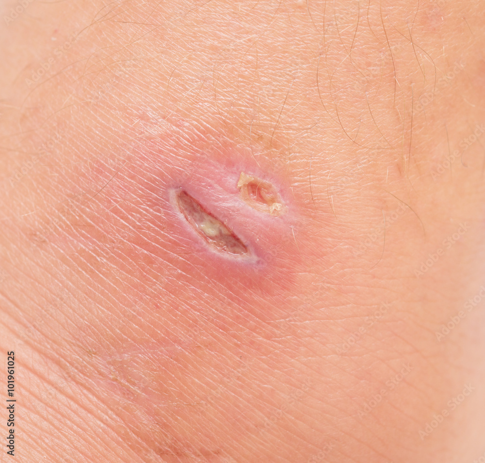Fototapeta premium wound
