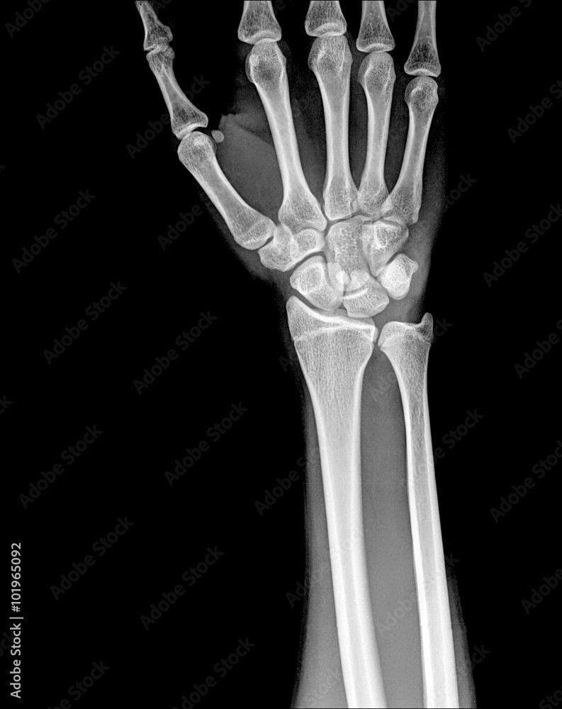 Fracture distal radius (wrist bone) Stock Photo Adobe Stock
