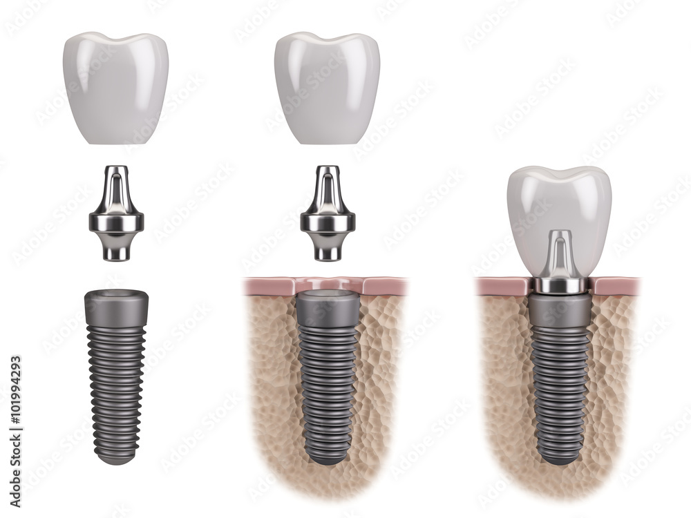 Fotografia Tooth human implant