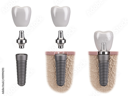 Tooth human implant photo