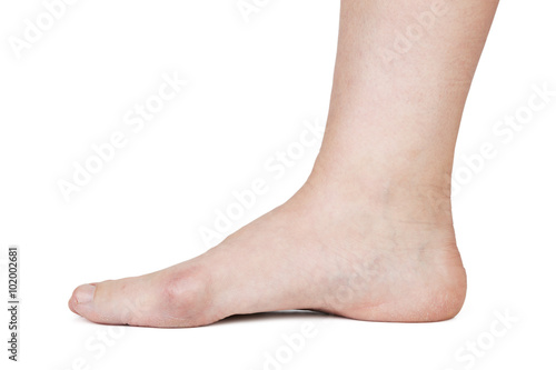 Human foot with hallux valgus © dimedrol68