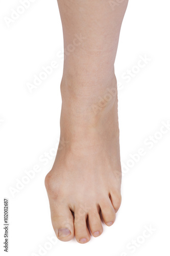 Leg with deformed joint