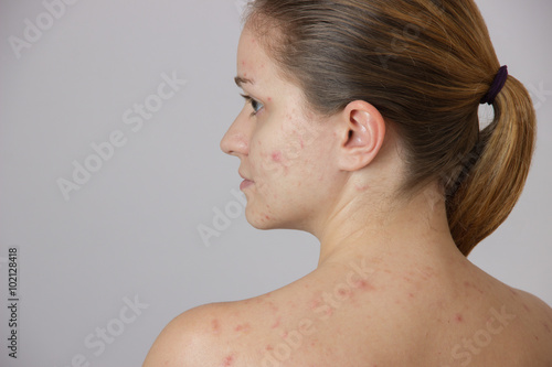 Beautiful young girl with acne on his face and the back on a whi