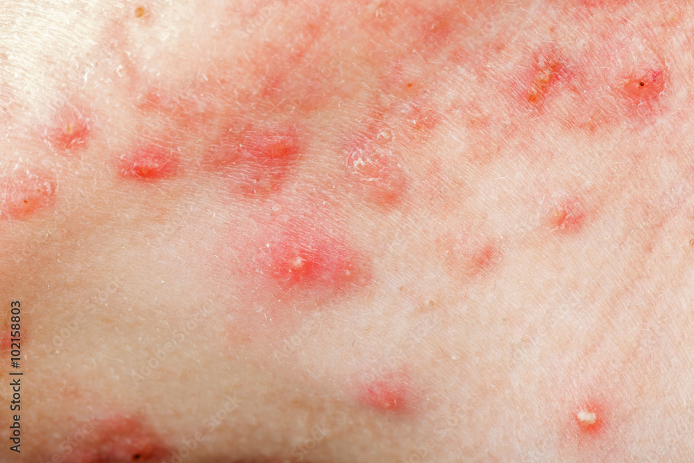 Nodular cystic acne skin