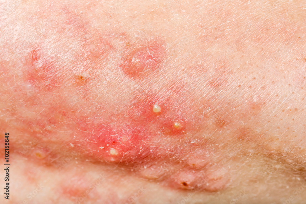 Nodular cystic acne skin Nodular cystic acne skin