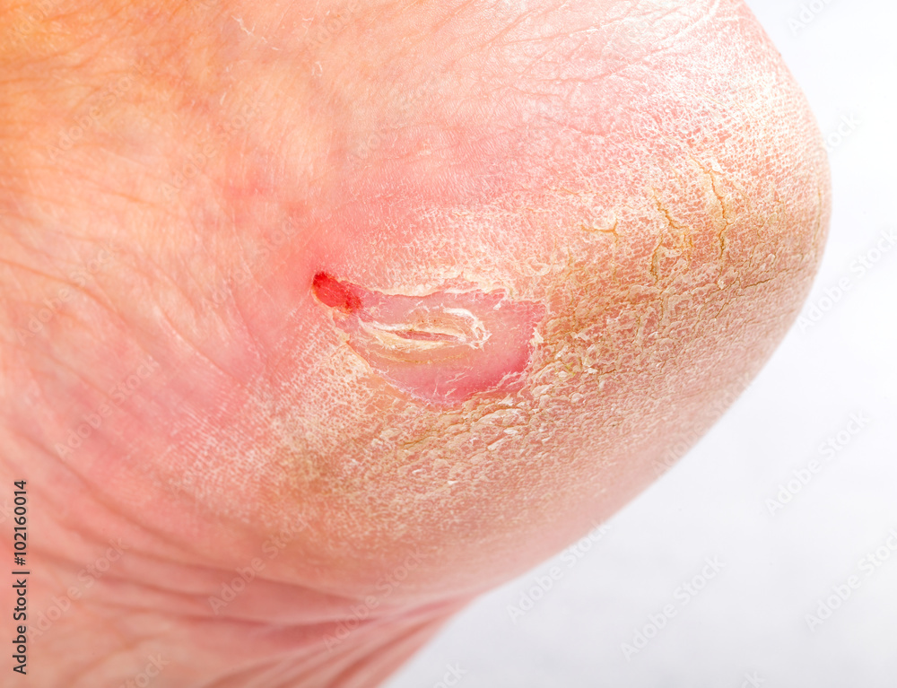 Fototapeta premium Dry skin on heel