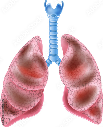 Illustration of Smokers Lungs
