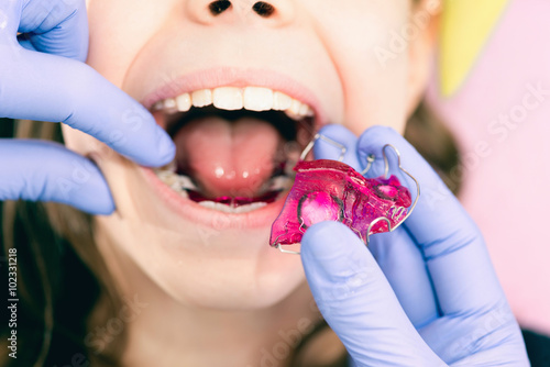 Dental braces. Dentist placing braces into little girl's mouth