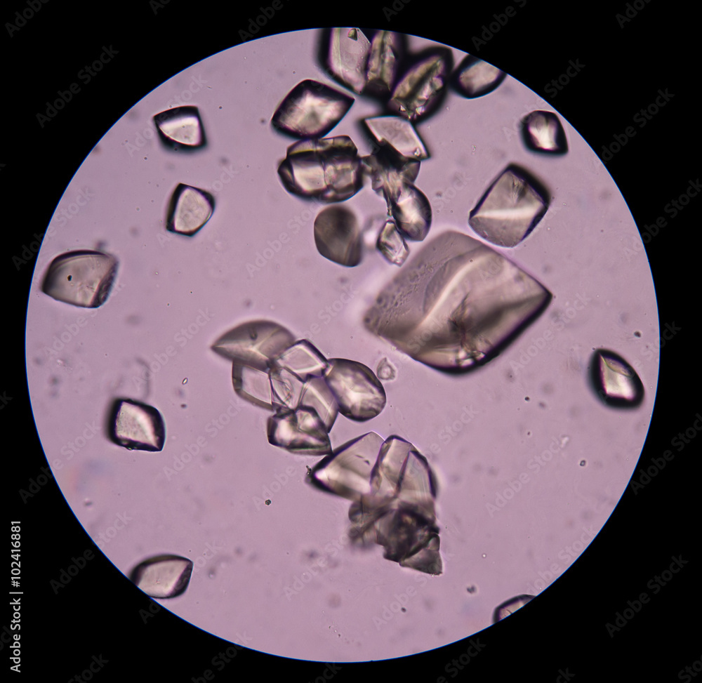 Uric acid in urine sediment Stock Photo | Adobe Stock