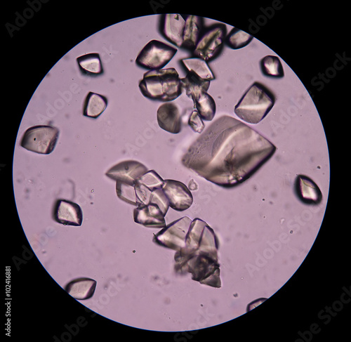 Uric acid in urine sediment