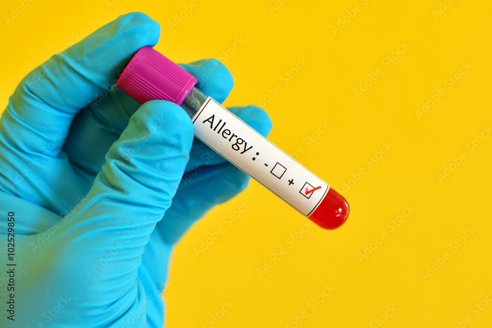 Obraz premium Blood sample positive with allergy testing