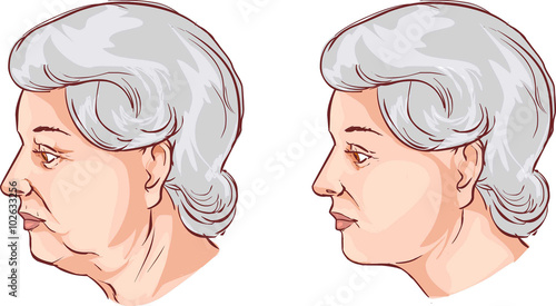 vector illustration of a  Face lift before and after treatment