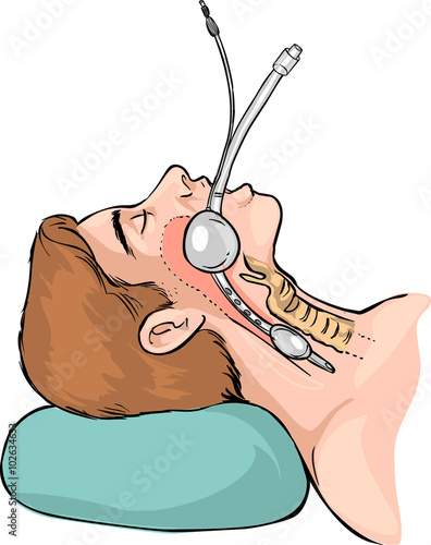 Vector illustration of a Technique of tubal intubation