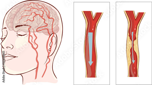 Vector illustration ofbrain stroke. Cerebral infarction