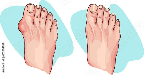 Vector illustration of bunion before and after operation