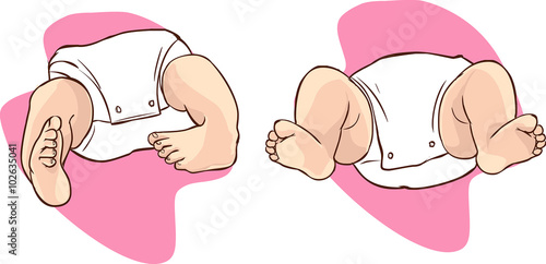 Newborn with bilateral club foot, also called congenital talipes