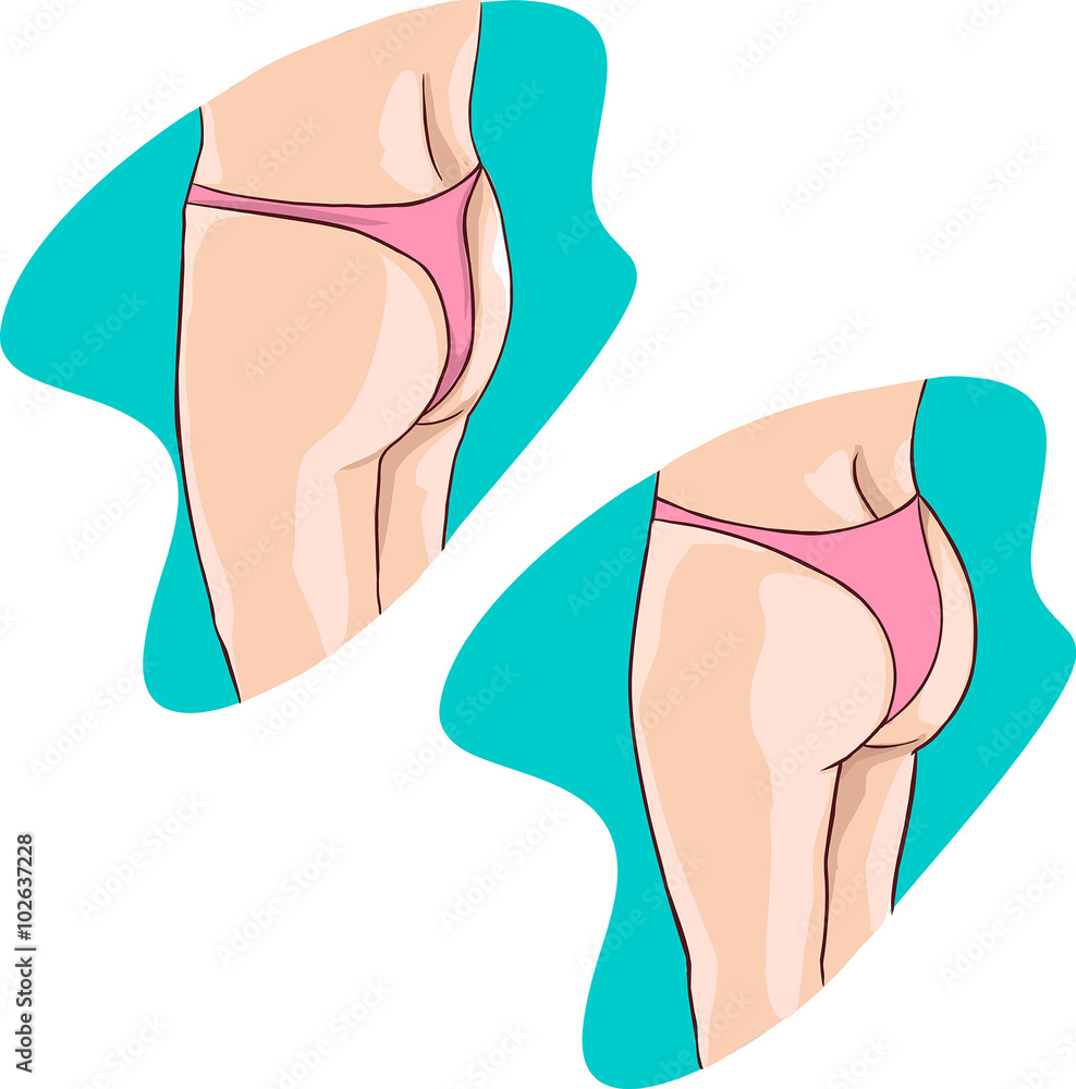 green backround vector illustration of a buttocks implants green backround vector illustration of a buttocks implants