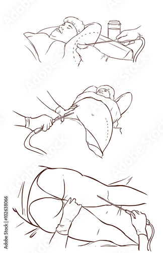 black and white  background vector illustration of a liposuction