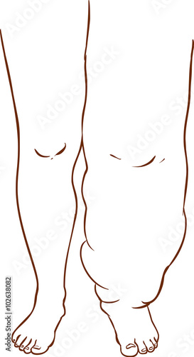 vector illustration of a Lymphedema of the disease