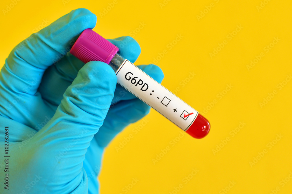 Obraz premium Blood sample positive with G6PD (Glucose-6-phosphate dehydrogenase) deficiency test 