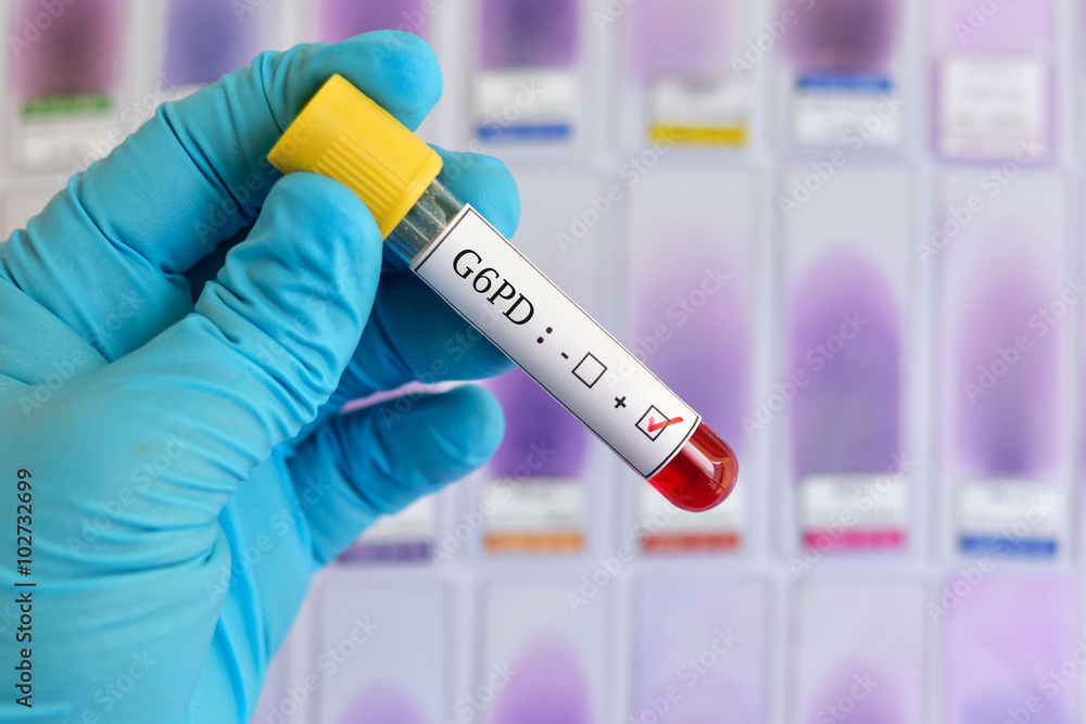 Blood sample positive with G6PD (Glucose-6-phosphate dehydrogenase) deficiency test
Blood sample positive with G6PD (Glucose-6-phosphate dehydrogenase) deficiency test