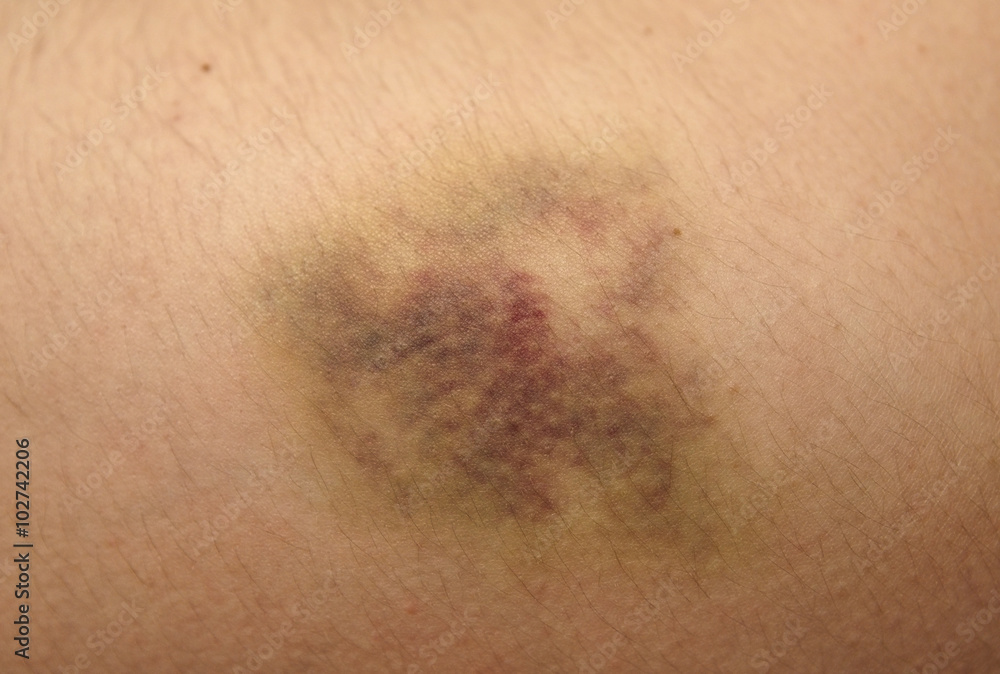 Nasty looking bruise, real Nasty looking bruise, real