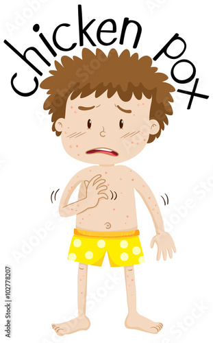 Boy having chicken pox