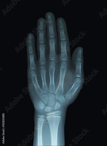 Child Hand X-Ray Unclosed Epiphysis
