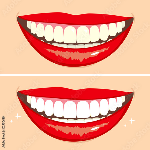 Illustration of two happy smiles showing before and after whitening teeth process