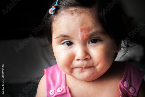 Infantile hemangioma