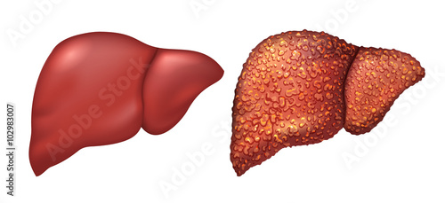 Liver of healthy person. Liver patients with hepatitis. Liver is sick person. Cirrhosis of liver. Repercussion alcoholism