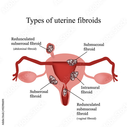Types of uterine fibroids. Endometriosis. Infographics. Vector illustration isolated on white background