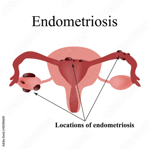 Endometriosis. Endometrial cysts. The structure of the pelvic organs. Gynecology. Infographics. Vector illustration 