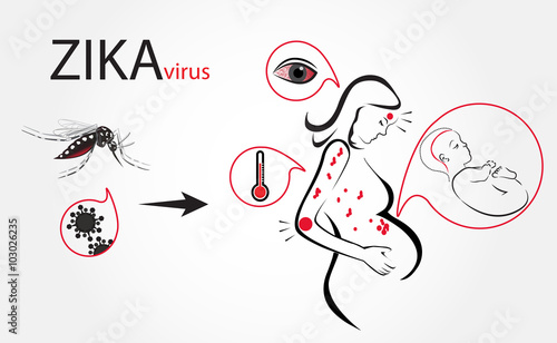 Zika virus fever infographic vector.
