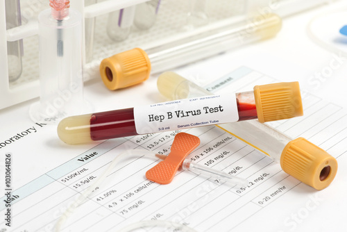 Obraz na plátně Hepatitis Test
