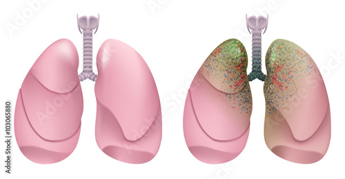 Healthy human lungs. Respiratory system. Lung, larynx and trachea of healthy person. Respiratory system smoker. Lung cancer