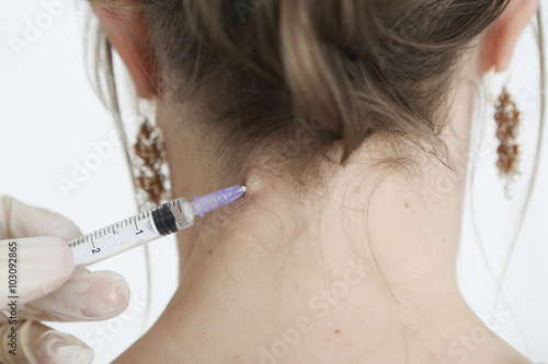 Fototapeta Mesotherapeutische Behandlung