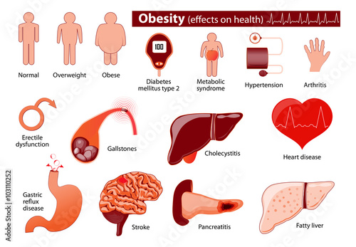 Obesity and overweight infographic