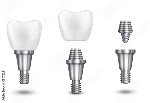 Tooth implant. Implant dental and health tooth, healthy implant, vector illustration