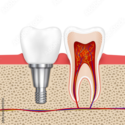 Healthy teeth and dental implant. Implant tooth, health tooth medical dentistry, vector illustration