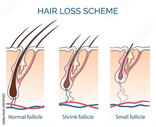 Hair loss scheme. Loss hair, growth hair problem, health hair. Vector illustration