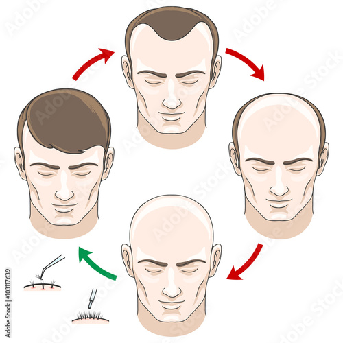 Stages of hair loss, hair treatment and hair transplantation. Hair loss, bald and care, health haor, human hair growth, vector illustration