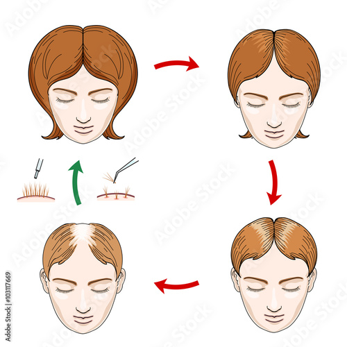 Female hair loss and hair transplantation icons. Hair loss woman, care hair, head female, scalp human, growth hair, vector illustration