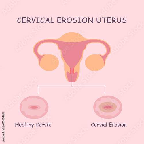 uterus and cervial erosion